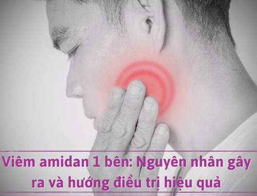 Viêm amidan 1 bên: Nguyên nhân gây ra và hướng điều trị hiệu quả